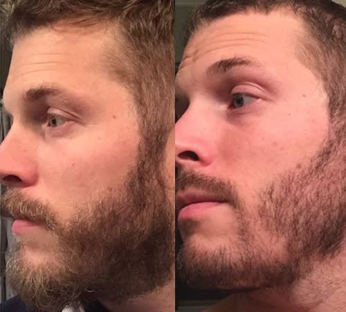 Grooming a Patchy Beard: All You Need To Know